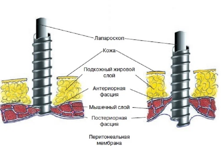 Канюли троакара TERNAMIAN EndoTIP